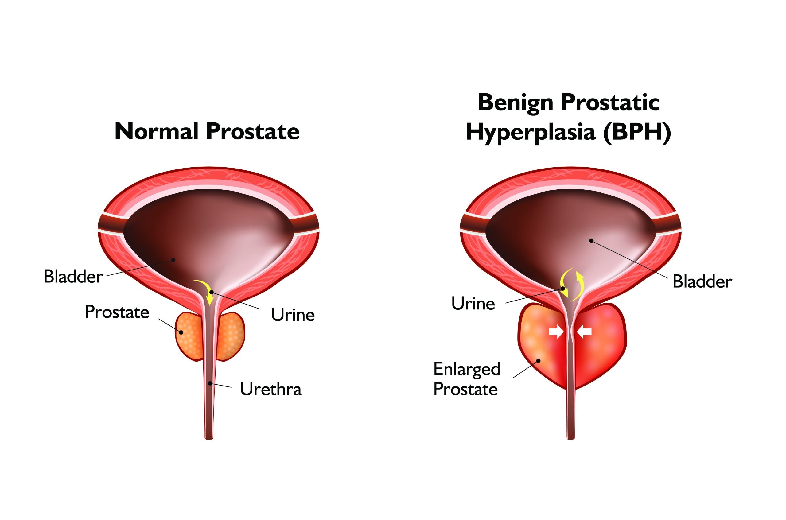 Normal prostate vs enlarged prostate